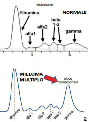 Risultati immagini per mieloma multiplo